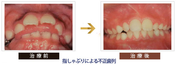 指しゃぶりによる不正歯列